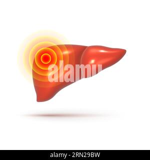 Lebererkrankung. Kranke schmerzhafte Leber 3D-Vektor-Illustration. Realistisches menschliches Organ auf weißem Hintergrund. Stock Vektor