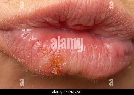 Makro von Lippen der Frau mit Lippenherpes. Herpes-simplex-Pusteln-Nahaufnahme bei einer weiblichen Mundhöhle. Stockfoto