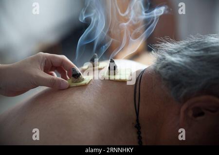 (170716) -- PEKING, 16. Juli 2017 -- Ein Arzt führt Moxibustion für einen Patienten im Gaoqing Hospital of Traditional Chinese Medicine in Gaoqing, Ostchinesische Provinz Shandong, 12. Juli 2017 durch. Als der heißeste Teil des Sommers in China beginnt, kommen viele Menschen ins Krankenhaus, um Krankheiten zu verhindern, indem sie Akupunktur und Schröpftherapie erhalten. ) WÖCHENTLICHE AUSWAHL VON XINHUA FOTO ZhangxWeitang PUBLICATIONxNOTxINxCHN 170716 Peking 16. Juli 2017 ein Arzt führt Moxibustion für einen Patienten IM Gaoqing Krankenhaus für traditionelle chinesische Medizin in Gaoqing Ostchina Provinz S Shan Dong 12. Juli 201 durch Stockfoto