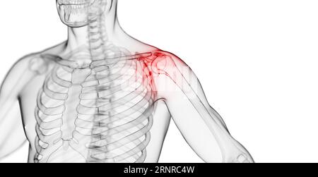 Mann mit Schulterschmerzen, Illustration Stockfoto
