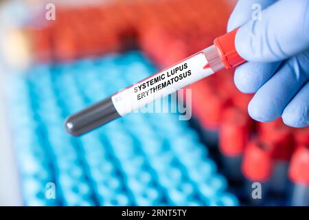 Systemischer Lupus Erythematodes. Systemische Lupus erythematodes-Krankheit Bluttest im medizinischen Labor Stockfoto