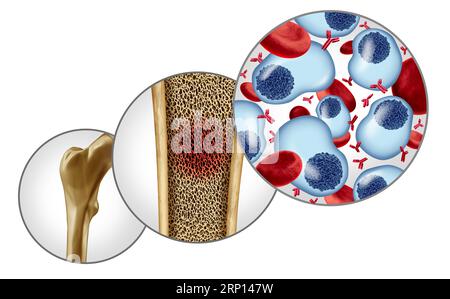 Multiples Myelomkonzept und Plasmazellkarzinom als Krebswachstum im Knochenmark Stockfoto