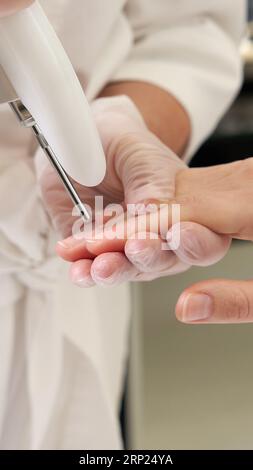 Laser-Behandlung von Nägeln in einem Schönheitssalon Stockfoto