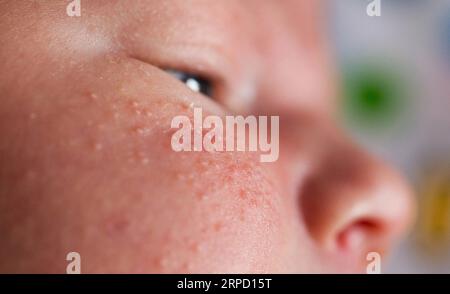 Ausschlag im Gesicht eines Neugeborenen. Der Entstehungsvorgang des Hormonsystems. Stockfoto