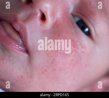 Pickel im Gesicht eines Neugeborenen. Babys Anpassung an die Umwelt. Stockfoto