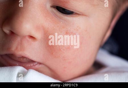 Allergische Pickel bei einem Neugeborenen im Gesicht. Pathogenese, Akne des Neugeborenen, Nahaufnahme Stockfoto