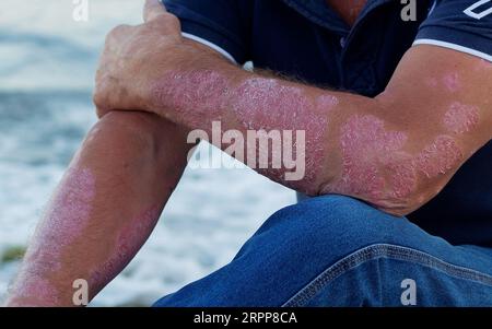 Dermatitis auf der Haut, kranker allergischer Ausschlag Dermatitis Ekzem Haut des Patienten, atopische Dermatitis Symptom Haut Detail Textur, Pilz der Haut, das Konzept Stockfoto