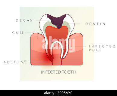 Infizierte Zähne - Wurzelkanalbehandlung - Stockbild als EPS 10 Datei Stock Vektor