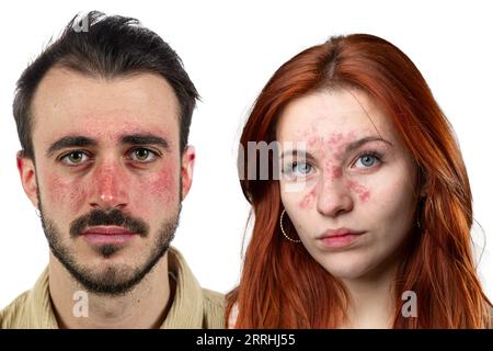 Couperose männlich und weiblich. Akne rosacea bei Mann und Frau. Rötung der Haut. Isolierte Personen auf weißem Hintergrund Stockfoto