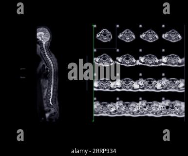 MRT-Ganzdorn-Screening zur Diagnose Rückenmarkskompression. Stockfoto