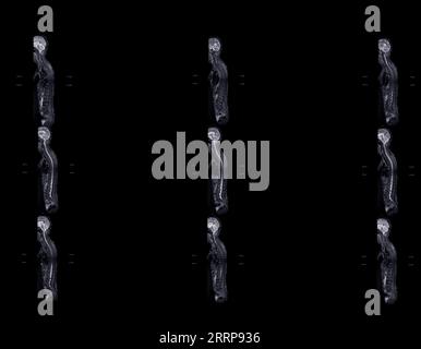 MRT-Ganzdorn-Screening zur Diagnose Rückenmarkskompression. Stockfoto