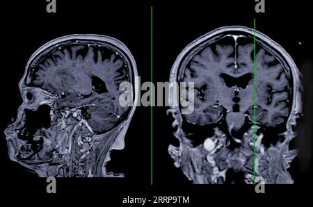 MRT-Hirnscan sagittale und koronale Ansicht mit Referenzlinie zur Erkennung von Hirnerkrankungen als Schlaganfallerkrankung, Hirntumoren und Infektionen. Stockfoto