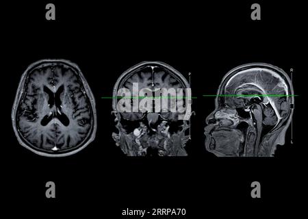 MRT-Hirnscan Axial-, koronale und sagittale Ansicht mit Referenzlinie zur Erkennung von Hirnerkrankungen als Schlaganfall, Hirntumoren und Infektionen. Stockfoto