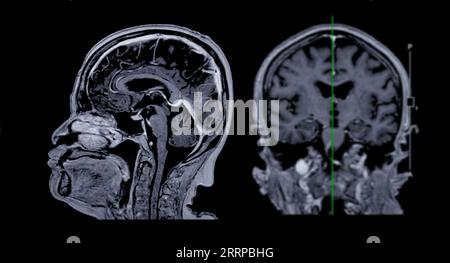 MRT-Hirnscan sagittale und koronale Ansicht mit Referenzlinie zur Erkennung von Hirnerkrankungen als Schlaganfallerkrankung, Hirntumoren und Infektionen. Stockfoto