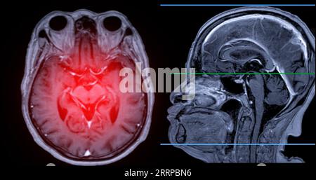 MRT-Hirnscan Axial- und sagittale Ansicht mit Referenzlinie zur Erkennung von Hirnerkrankungen als Schlaganfallerkrankung, Hirntumoren und Infektionen. Stockfoto