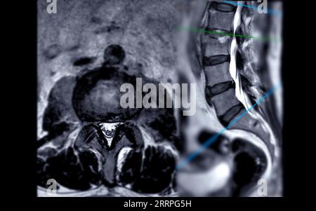 MRT L-S Wirbelsäule oder Lendenwirbelsäule axiale und sagittale T2-Technik mit Referenzlinie zur Diagnostik der Rückenmarkkompression. Stockfoto