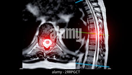 MRT-T-L-Wirbelsäule oder Thorakosakrale Wirbelsäule axiale und sagittale T2-Technik mit Referenzlinie zur Diagnostik der Rückenmarkkompression. Stockfoto