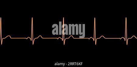 Abbildung eines Elektrokardiogramms (EKG) mit einem normalen Herzrhythmus bei einer gesunden Person. Stockfoto