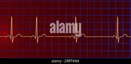 Sinusarrhythmie Herzrhythmus, Illustration Stockfoto