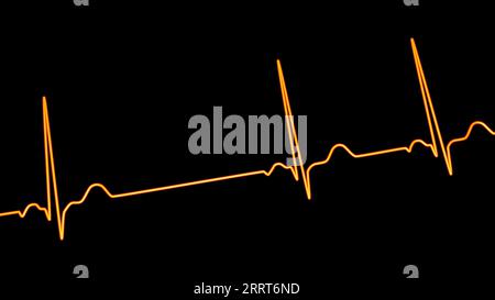 Sinusarrhythmie Herzrhythmus, Illustration Stockfoto