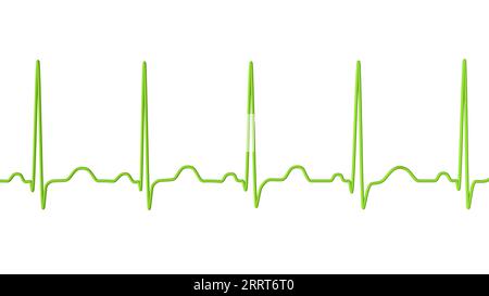 Sinustachykardie Herzrhythmus, Illustration Stockfoto