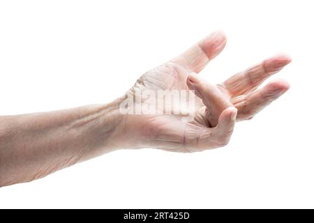 Hand einer alten Frau mit Dupuytren-Kontraktur Stockfoto