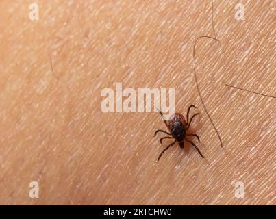 Infizierte weibliche Hirschzecke auf behaarter menschlicher Haut. Ixodes ricinus. Parasitäre Milbe. Acarus. Gefährliches Bissinsekt auf Epidermis-Detailhintergrund. Disg Stockfoto