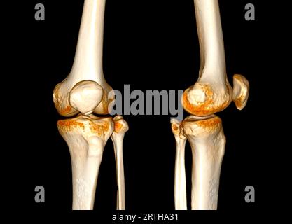 CT-Scan des Kniegelenkes mit 3D-Darstellung der Patellafraktur. Stockfoto