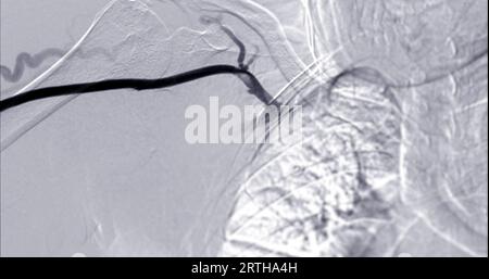 Bild der Angioplastie, Ballonangioplastie und perkutanen transluminalen Angioplastie (PTA). Stockfoto