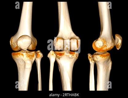 CT-Scan des Kniegelenkes mit 3D-Darstellung der Patellafraktur. Stockfoto