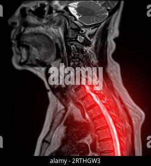 MRT der C-Wirbelsäule oder Magnetresonanzbild der sagittalen T2 FS-Ansicht der Halswirbelsäule zur Diagnose der Spondylose, die die zervikale spondylotische Myelopathie A verursacht Stockfoto