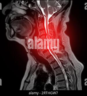 MRT der C-Wirbelsäule oder Magnetresonanzbild der sagittalen T2 FS-Ansicht der Halswirbelsäule zur Diagnose der Spondylose, die die zervikale spondylotische Myelopathie A verursacht Stockfoto