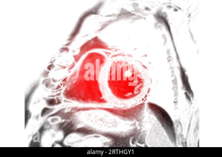 MRT Herz- oder Herz-MRT ( Magnetresonanztomographie ) der Kurzachsenansicht des Herzens zur Diagnose der Herzkrankheit. Stockfoto