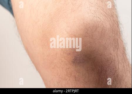 Lila blaue Flecken auf dem menschlichen Knie Makro Nahansicht Stockfoto