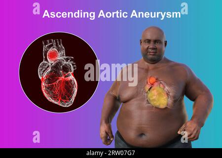 Adipöser Mann mit Aortenaneurysma ascendens, Illustration Stockfoto