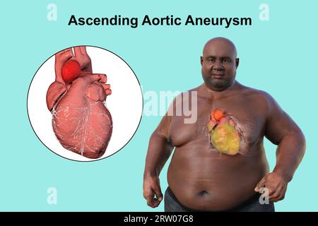 Adipöser Mann mit Aortenaneurysma ascendens, Illustration Stockfoto