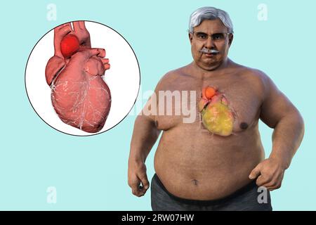 Adipöser Mann mit Aortenaneurysma ascendens, Illustration Stockfoto