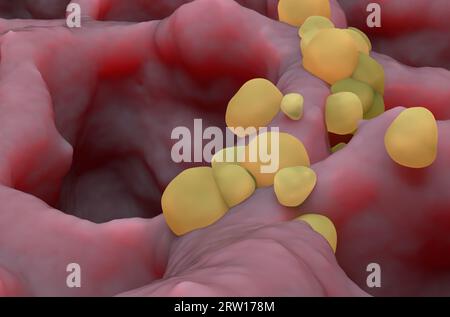 Kleine Krebstumoren im Lungengewebe: Lungenkrebs (LC) - Nahaufnahme 3. Illustration Stockfoto