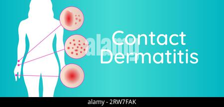 Kontaktdermatitis-Hintergrund-Illustration mit Frau und Irritationscloseups Stock Vektor