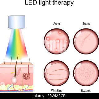 LED-Lichttherapie bei Hautproblemen, wie Akne-Behandlung, Narben- und Faltenreduktion und Ekzemmanagement. Phototherapie bei Hautrejuvenaten Stock Vektor