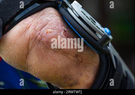 Frau mit Post-OP-Ellenbogenstütze nach Ellbogenbruch und Operation. Nahaufnahme mit Narbe. Stockfoto