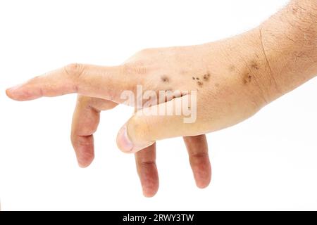 Männliche Hand, trocken und mit Hautflecken, dermatologisches Problem, Beginn der Sonnenmelanose, Haut ohne Sonnenschutzmittel, isoliert auf weißem Hintergrund, Stockfoto