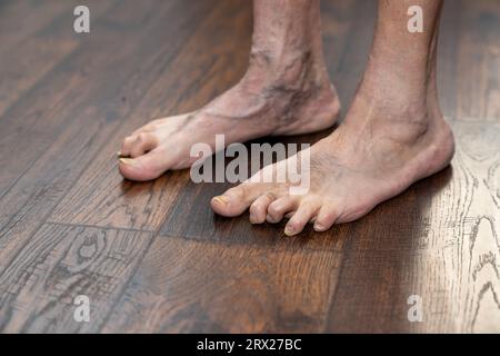 Die deformierten Hammerhöhlen des Mannes zeigen den linken Fuß ein Jahr nach der Operation Stockfoto