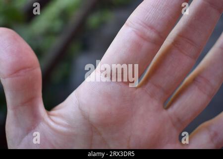 Der Druck eines getöteten Aedes albopictus, auch bekannt als asiatische Tigermücke an einer Hand. Diese Art hat sich in viele Länder ausgebreitet. Es hat das weiß Stockfoto