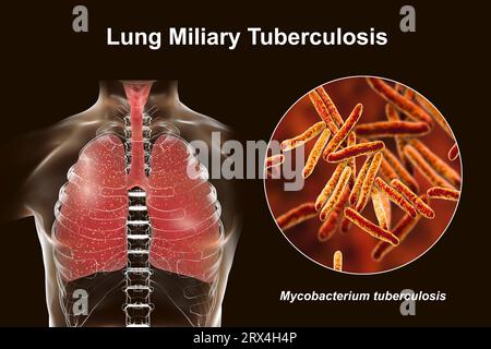 Lungen mit Miliartuberkulose, Illustration Stockfoto