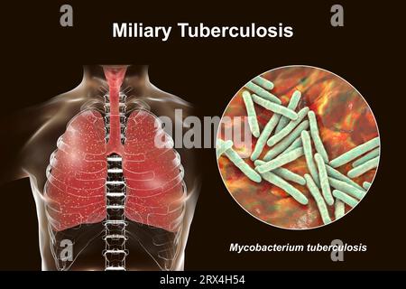 Die von Miliartuberkulose betroffene menschliche Lunge, mit einer Nahaufnahme der für die Infektion verantwortlichen Bakterien des Mycobacterium tuberculosis. Stockfoto