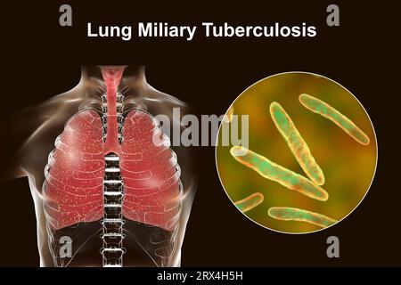 Lungen mit Miliartuberkulose, Illustration Stockfoto