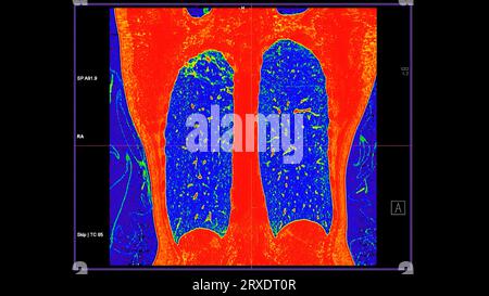 CT-Scan der koronalen Thoraxansicht im Farbmodus für diagnostische Lungenembolie (PE), Lungenkrebs und covid-19. Stockfoto