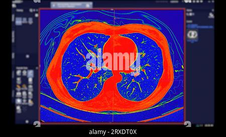 CT-Scan der koronalen Thoraxansicht im Farbmodus für diagnostische Lungenembolie (PE), Lungenkrebs und covid-19. Stockfoto