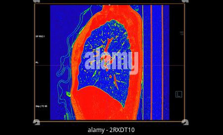 CT-Scan der koronalen Thoraxansicht im Farbmodus für diagnostische Lungenembolie (PE), Lungenkrebs und covid-19. Stockfoto